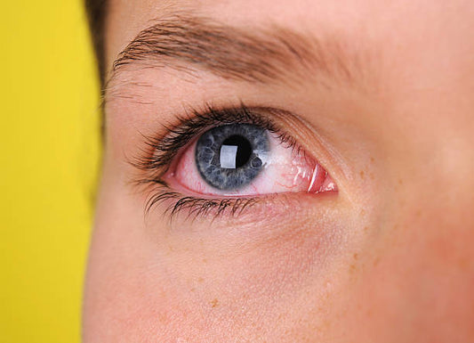 How to treat sore eyes